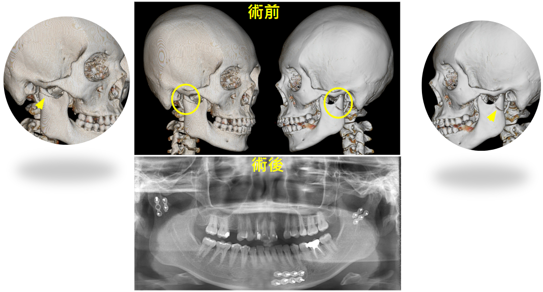 顳顎關節骨折